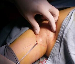 腋臭最新治疗步骤指南及疗法概述