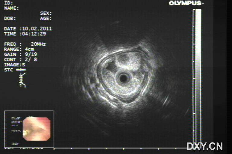 最新胃镜做法,最新胃镜做法,小巷深处的隐藏美食宝藏探秘
