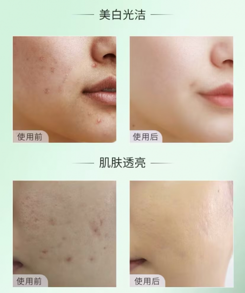 痤疮最新药物引领治疗新时代