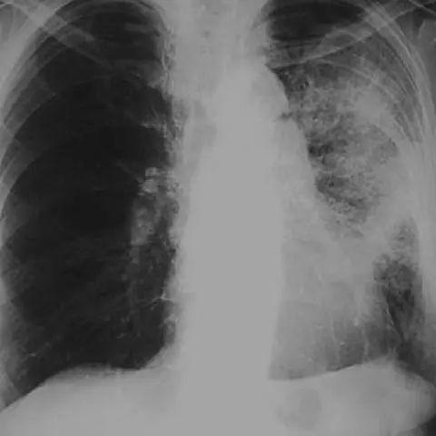 全面指南，最新肺炎病例详解，了解、预防与应对的步骤指南