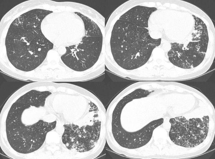 全面指南,最新肺炎病例详解,了解、预防与应对的步骤指南