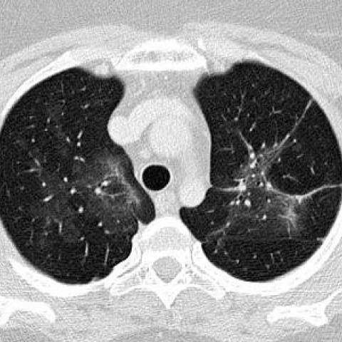 全面指南,最新肺炎病例详解,了解、预防与应对的步骤指南
