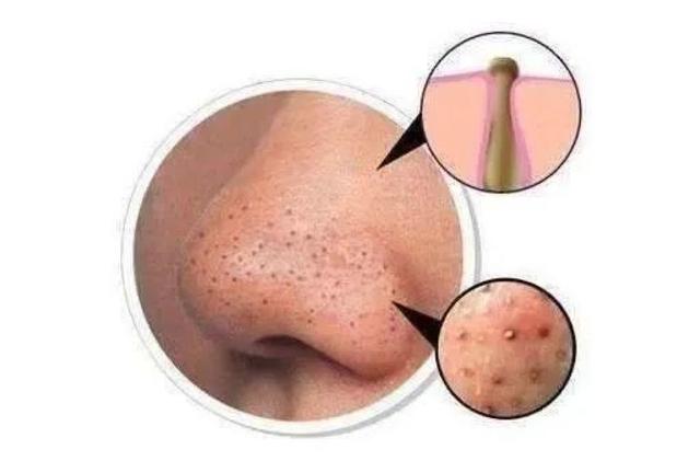 最新挤螨虫技术，战胜皮肤微小挑战的利器