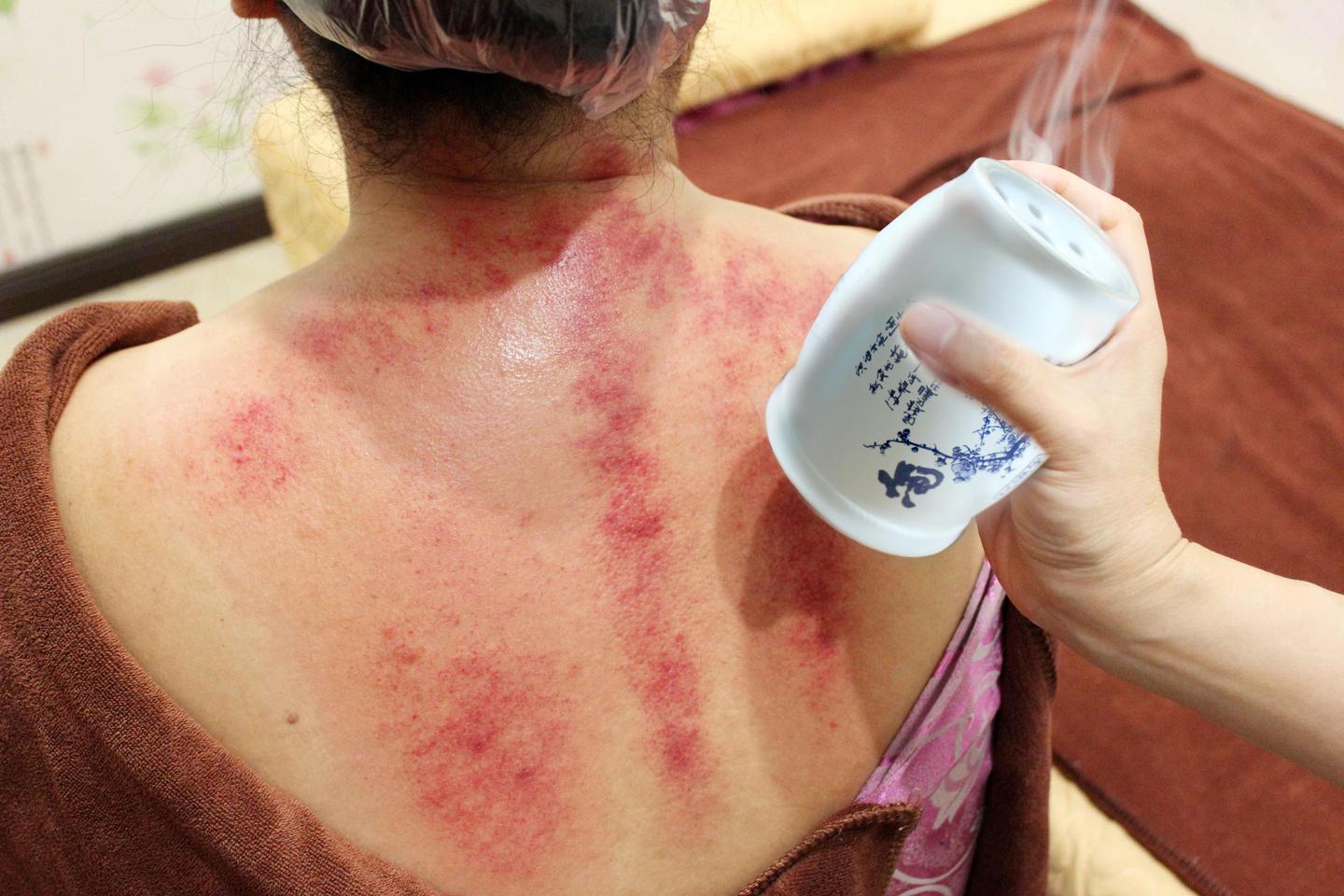 最新揪痧法及其观点论述