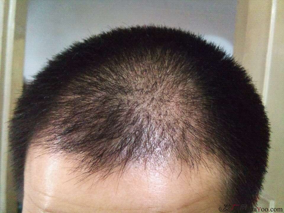 日本最新植发技术，革新与审美变革的交融