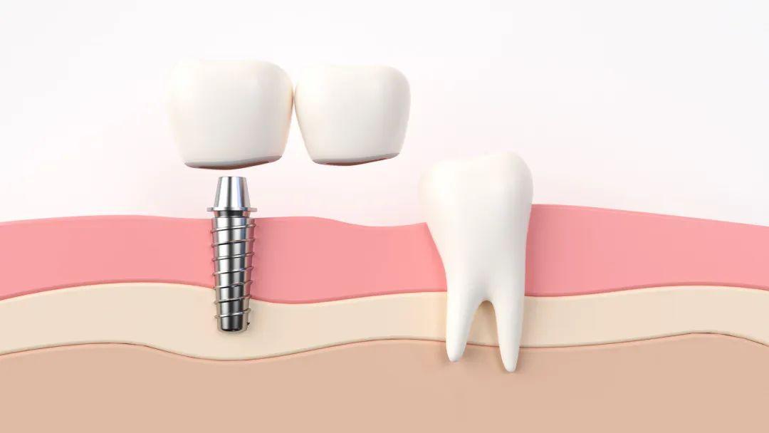 一颗种植牙市场价格,一颗种植牙市场价格,变化、学习与自信的力量