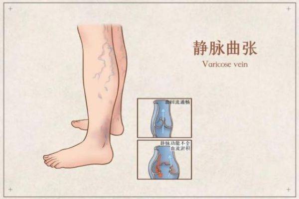 静脉曲张创新治疗法详解,步骤指南与突破性研究实践