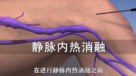 静脉曲张创新治疗法详解,步骤指南与突破性研究实践