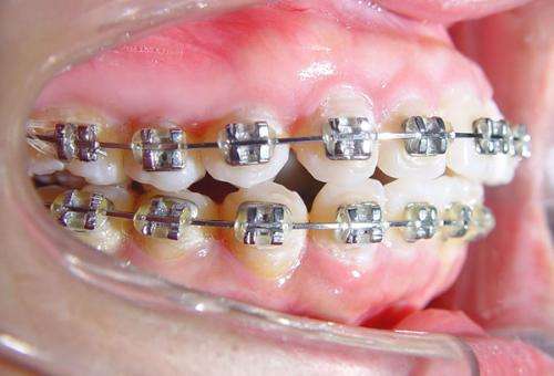 最新矫正器,最新矫正器，重塑自信的利器