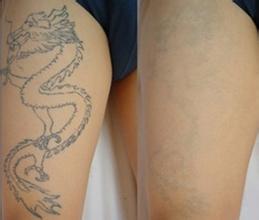 洗纹身的真正价值，蜕变之始，超越价签的价格解读