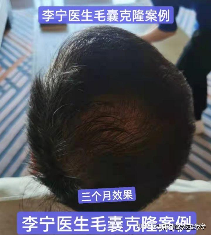 毛囊移植技术最新进展,重塑自信,从头开始重塑人生自信毛囊移植技术更新动态