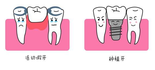 最新种牙技术重塑微笑,友谊更牢固