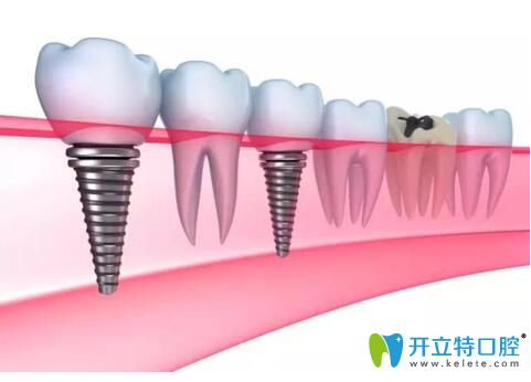 最新种牙技术重塑微笑,友谊更牢固